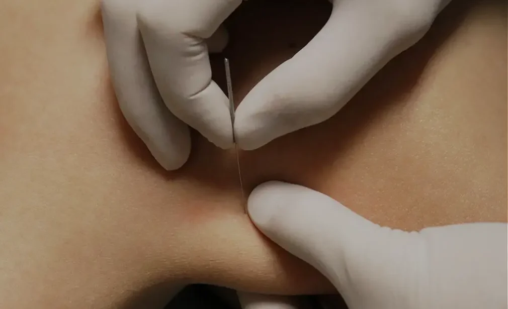 Dry-Needling-Physiolite