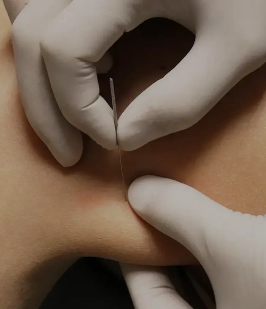 Dry-Needling-Physiolite